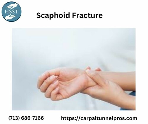 Learn about Scaphoid Fractures in-depth with the help of knowledgeable insights. To ensure a quick recovery, become knowledgeable about the signs, diagnosis, and efficient therapies. Count on our resources to provide you with accurate and compassionate guidance as you comprehend, manage, and recover from a scaphoid fracture.
Visit our website: https://carpaltunnelpros.com/2020/03/30/what-causes-burning-hands-and-how-can-you-treat-it/