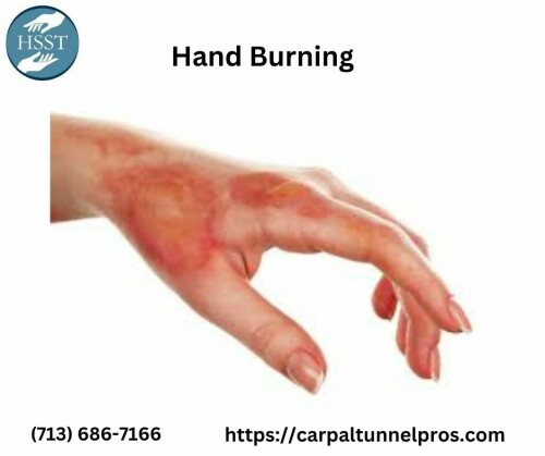 Use our focused solutions to relieve Hand Burning and experience immediate comfort. Find efficient treatments to relieve and heal irritated hands, whether they are caused by daily activities, skin conditions, or environmental factors. With our customised solutions and professional assistance, you can enjoy pain-free hands once more. Visit for more - https://carpaltunnelpros.com/2020/03/30/what-causes-burning-hands-and-how-can-you-treat-it/